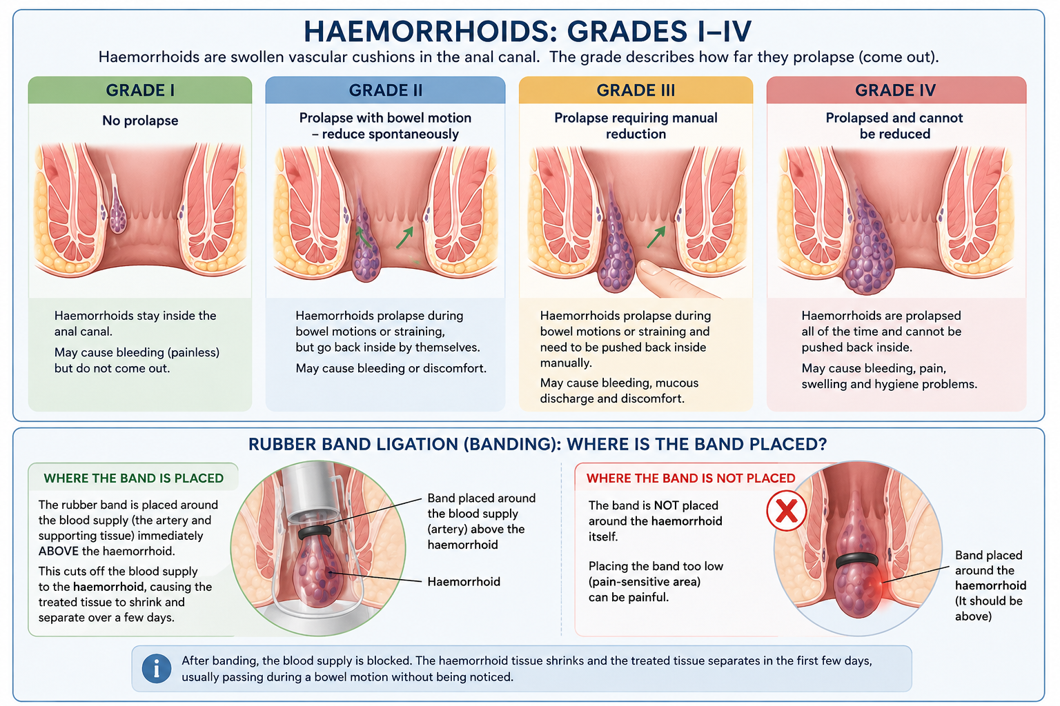 Diagram showing the four grades of haemorrhoids and the correct position of a rubber band during ligation